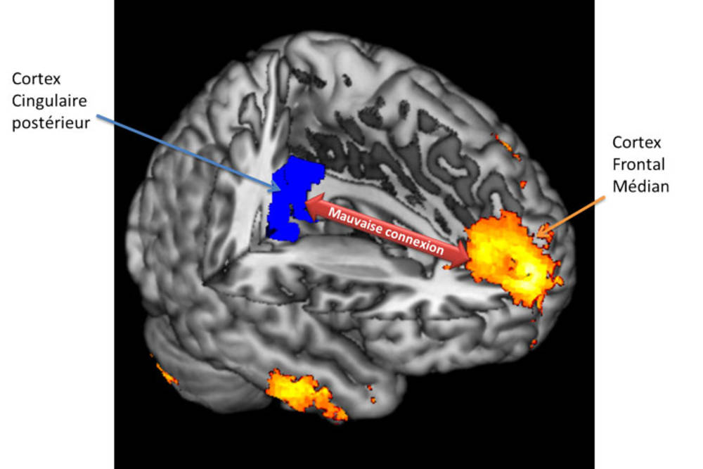 Représentation 3D du cerveau et des zones impliquées (en bleu le cortex cingulaire postérieur, en jaune le cortex frontal médian) 