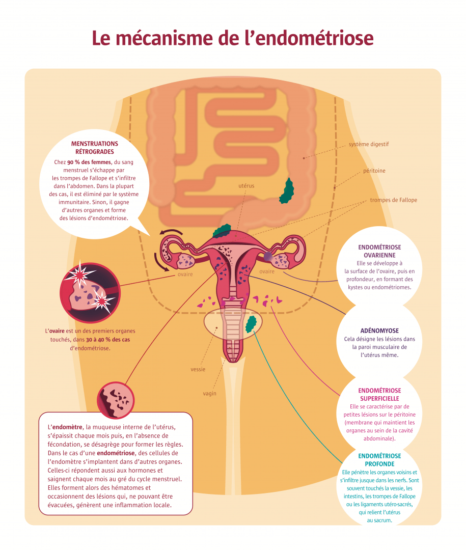 infographie