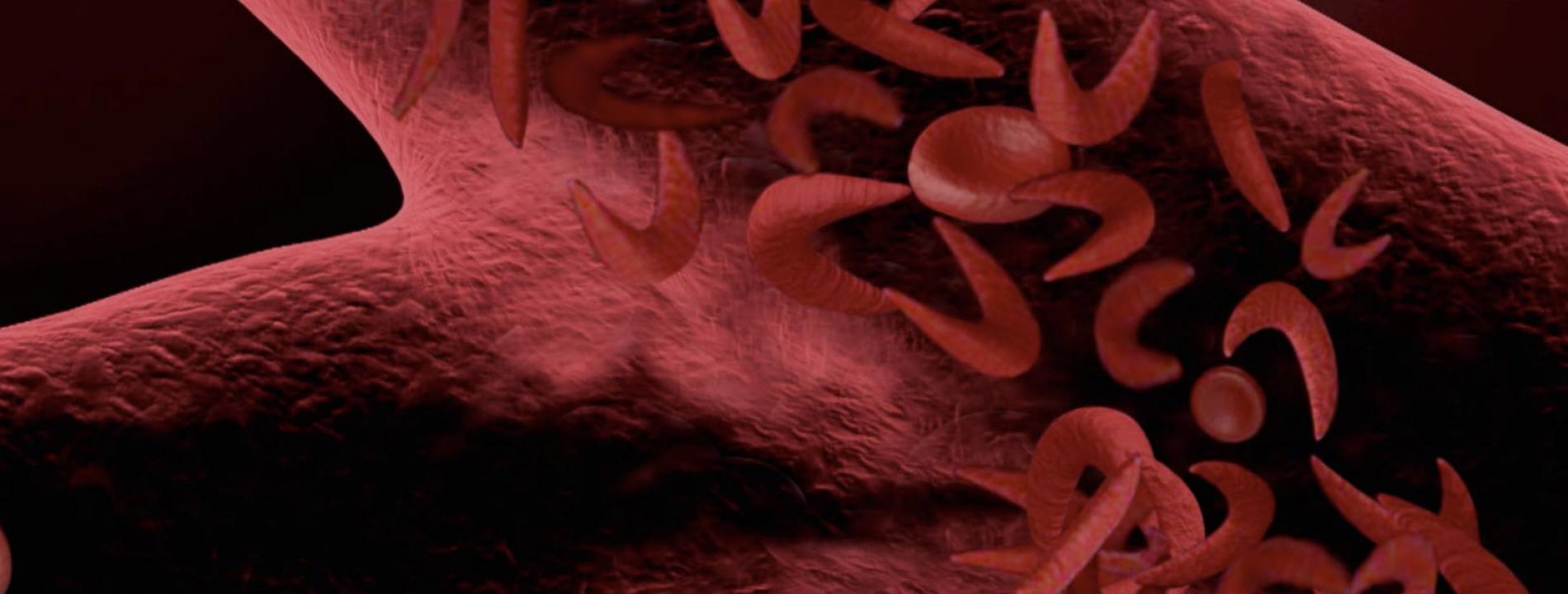 illustration drepanocytose