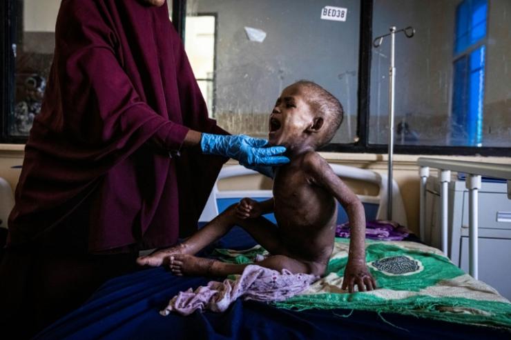 Ali Abdullahi Mohamed, 27 mois, souffrant de malnutrition sévère, est examiné par une infirmière dans un hôpital de Mogadiscio, en Somalie en proie à la sécheresse, le 1er juin 2022 © AFP Ed RAM