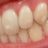 Les effets du surdosage de fluorure sur les dents enfin compris
