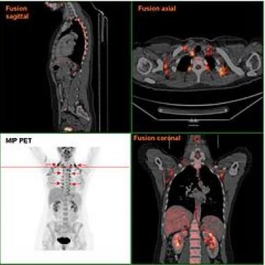 Du gras beige pour combattre l’obésité