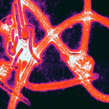 Ebola : des séquelles après la guérison