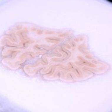 Un cerveau reconstruit post mortem 