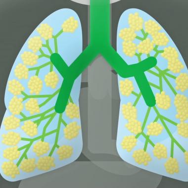 See video of Pneumonia