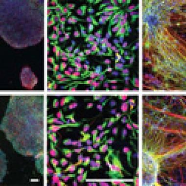 Fabrique de neurones et patients schizophrènes