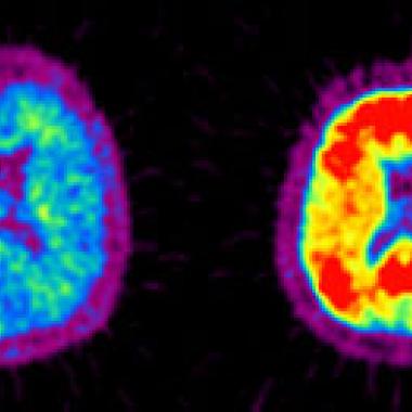Maladie d’Alzheimer : va-t-on bientôt la prédire ?