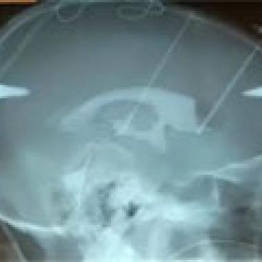 Maladie de Parkinson : quel avenir à l'électrostimulation ?