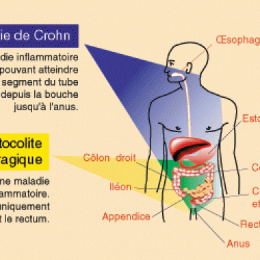 Maladie de Crohn : la découverte d'un gène de prédisposition