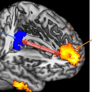 Un nouvel indicateur pour pronostiquer une sortie de coma