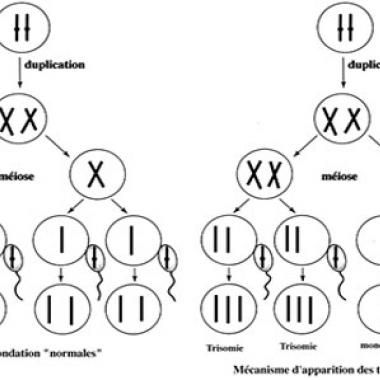 Trisomie 21 : sur la piste de la thérapie chromosomique 