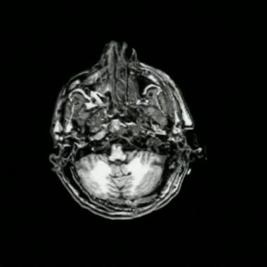 Voir la vidéo de IRM structurelle / cerveau