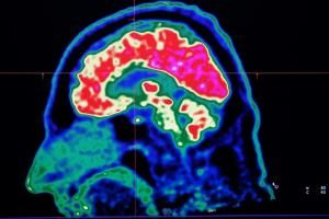 Comment le cerveau accroît ou diminue la perception de la douleur 
