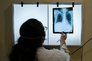 Hausse des nouveaux cas de tuberculose, une première en plus de 20 ans (OMS)