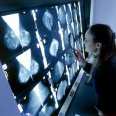 Cancer du sein : un dépistage efficace ?