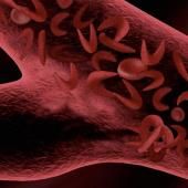 Vivre avec la drépanocytose