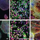 Fabrique de neurones et patients schizophrènes