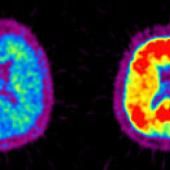 Maladie d’Alzheimer : va-t-on bientôt la prédire ?