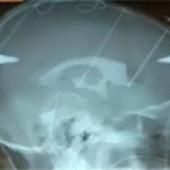 Maladie de Parkinson : quel avenir à l&#039;électrostimulation ?