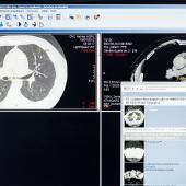Contre la détresse respiratoire, vers une lecture automatique des scanners ?
