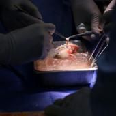 Des chirurgiens américains ont transplanté un rein de porc sur un patient vivant, une première