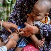 Bangladesh : l’épidémie de rougeole s’aggrave, avec 194 décès au total 