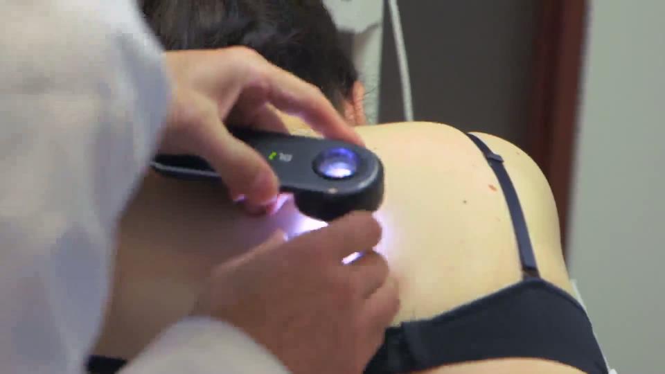 Des objets connectés contre le cancer de la peau